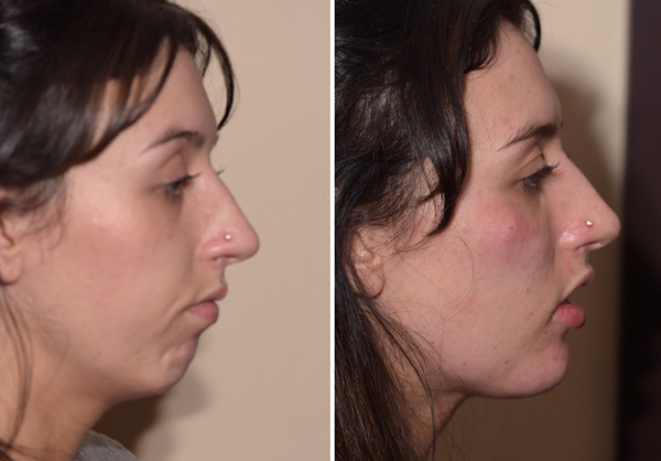 Non-surgical chin augmentation in Burnley